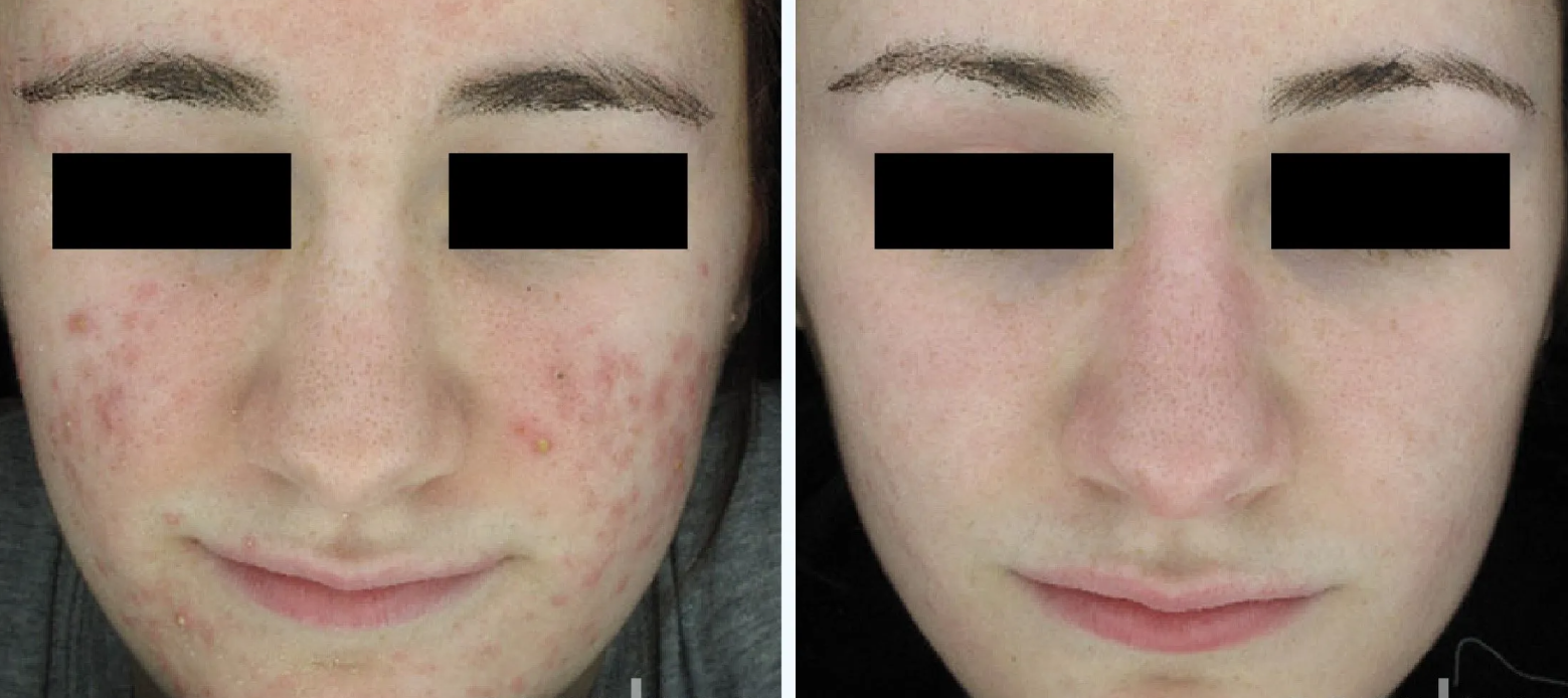 ACNE treatment Missouri 