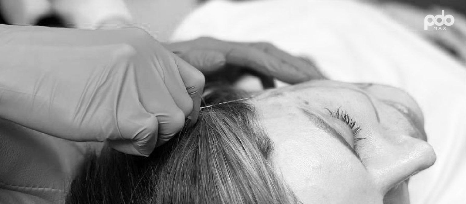 Lift & Tighten Skin, Thread Lifts in Lake of the Ozarks